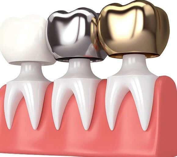 How-Same-Day-Dental-Crowns-Work-Its-Advantages