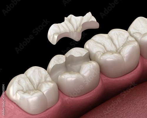 Inlay-ceramic-crown-fixation-over-tooth_-Medically-accurate-3D-illustration-of-human-teeth-treatment
