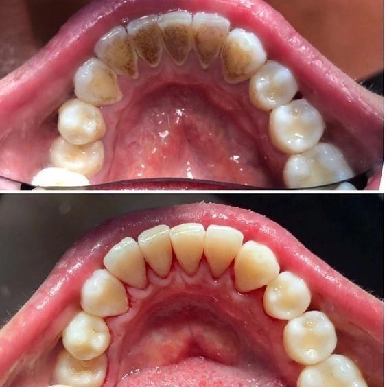 كل شيء عن تبييض الأسنان | عيادة طب الأسنان الدكتورة مهدخت إقدسي