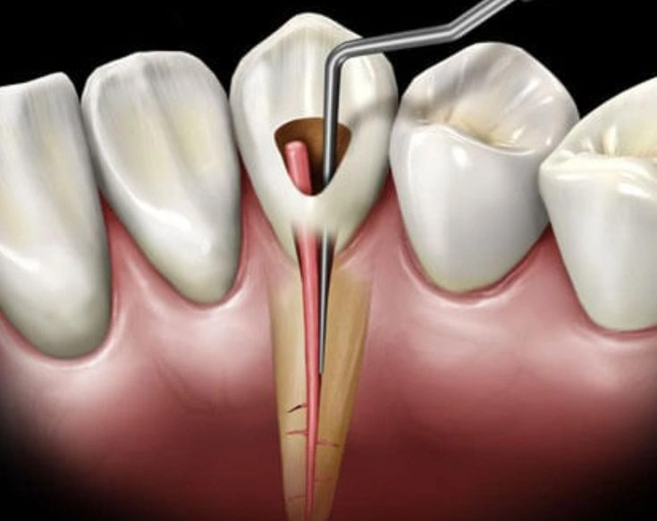 Root-Canal-Treatment-Istanbul