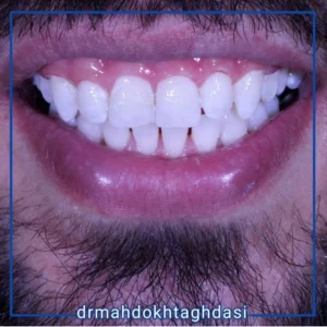 همه چیز درباره بلیچینگ دندان | مرکز دندانپزشکی دکتر مهدخت اقدسی