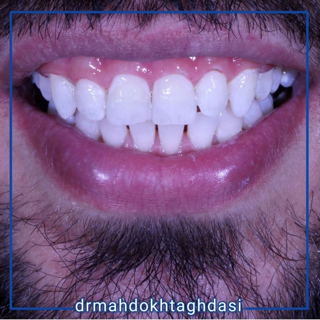 همه چیز درباره بلیچینگ دندان | مرکز دندانپزشکی دکتر مهدخت اقدسی