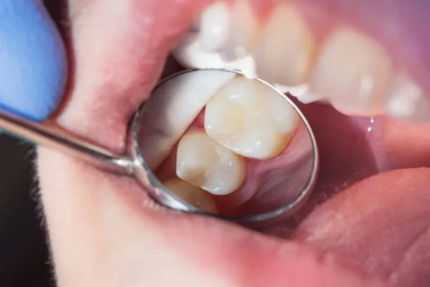 الكومبوزيت IPS في مشهد - مقارنة شاملة بين الكومبوزيت العادي وIPS