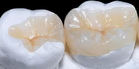 روکش دندان با آنله سرامیکی در مشهد