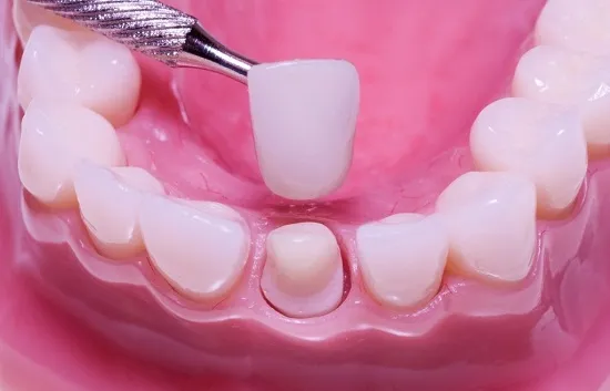 جدیدترین روکش دندان در مشهد - روکش زیرکونیا (Zirconia)